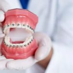 The results you can achieve by getting dental braces