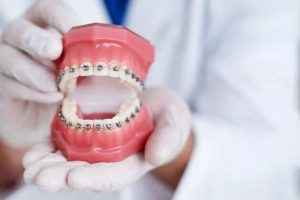 The results you can achieve by getting dental braces